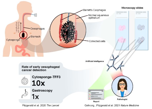 Infographic explaining use of the cytosponge device in early detection of oesophageal cancer